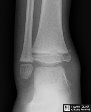 Salter-Harris 4 Fracture